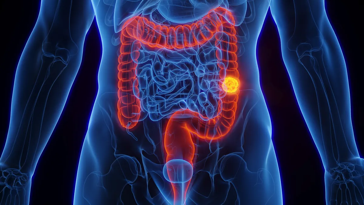 SUS inclui novo teste de alta tecnologia para rastreamento de câncer de intestino